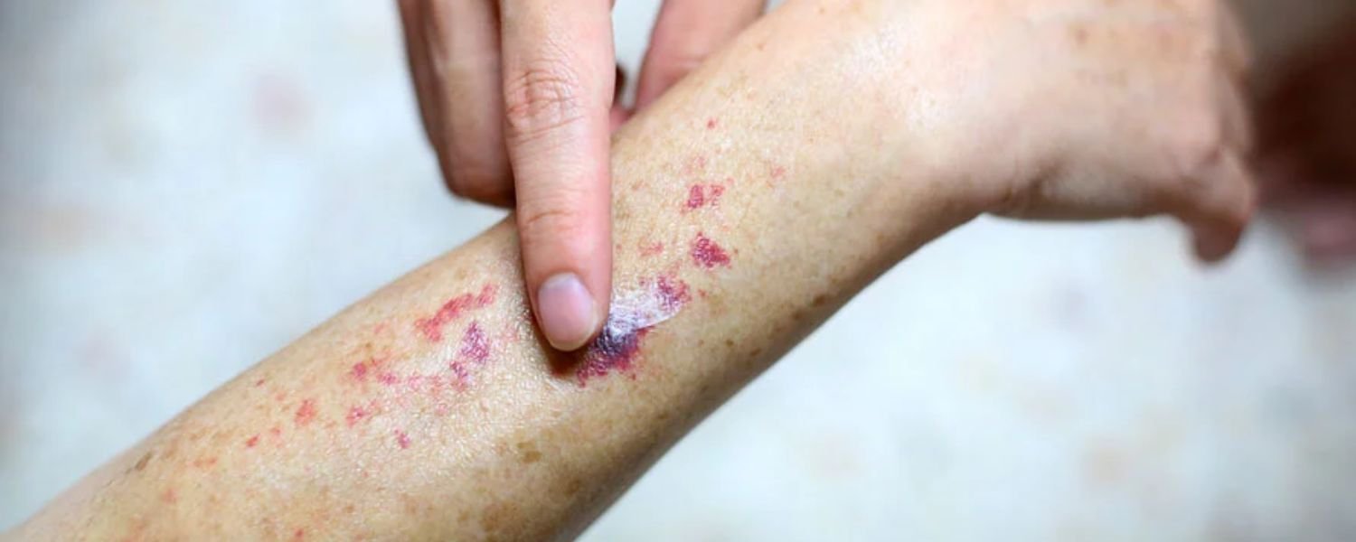 Types of Leukemia Rash