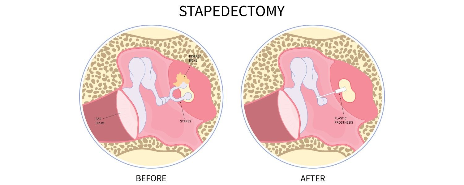 Stapedectomy