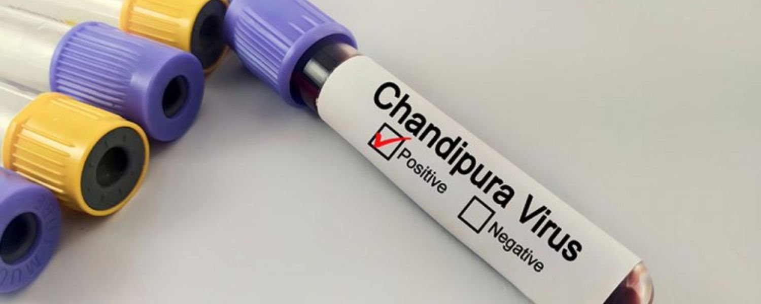 Management Tips for Chandipura Virus Infection